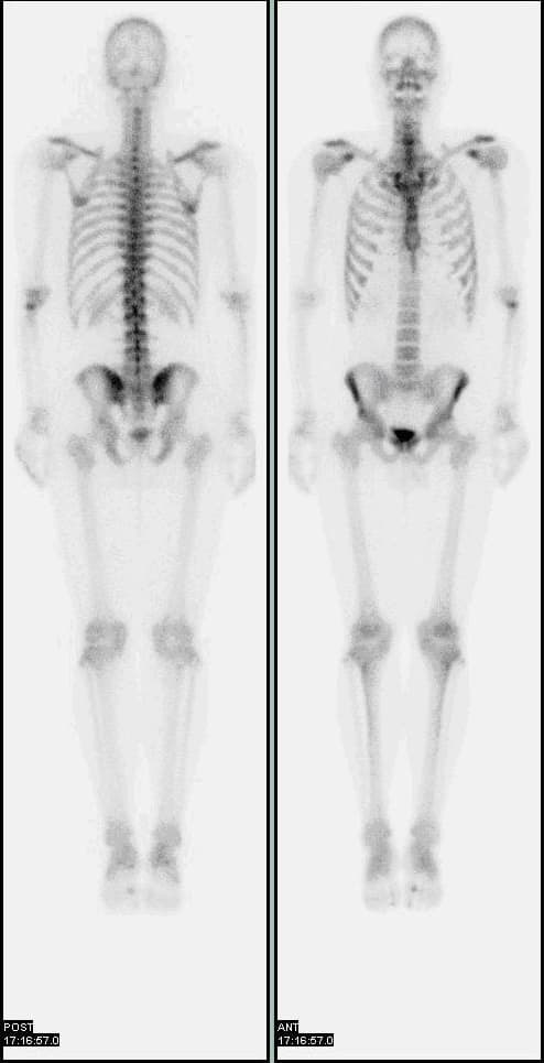 Bone scintigraphy