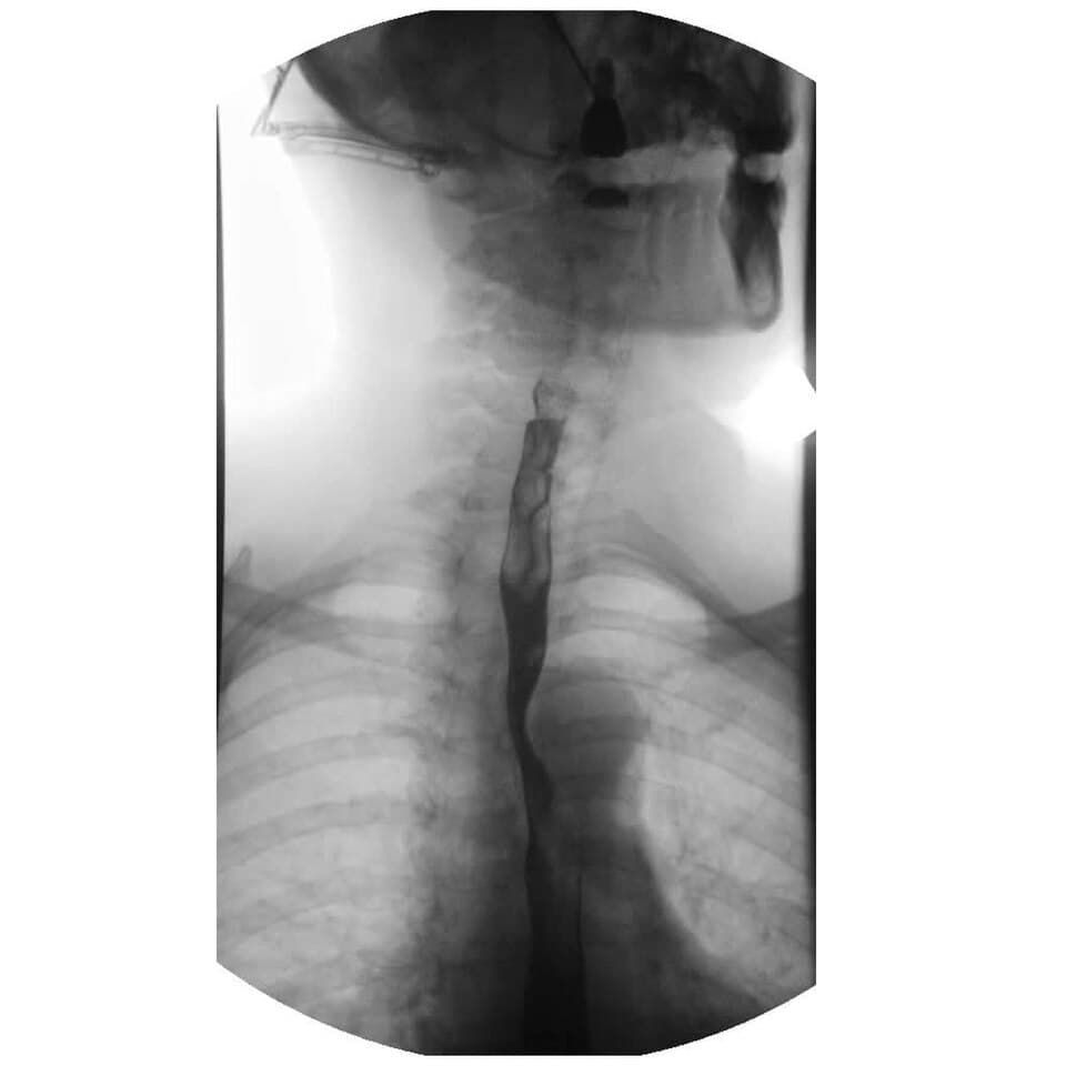 Upper gastrointestinal series