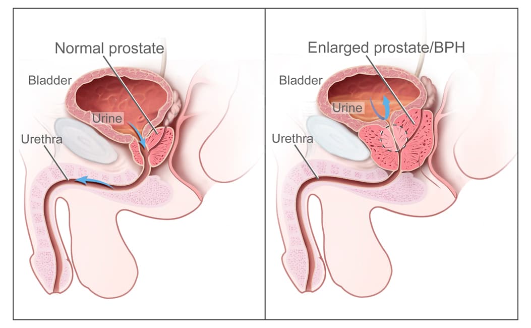 Benign prostatic hyperplasia